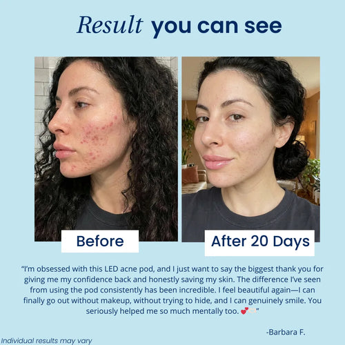 SkeenPod - Hands-Free LED Acne Pod: Targets Breakouts & Blemishes