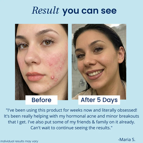 SkeenPod - Hands-Free LED Acne Pod: Targets Breakouts & Blemishes