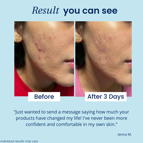 SkeenPod - Hands-Free LED Acne Pod: Targets Breakouts & Blemishes